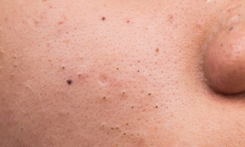 Home Remedies for Removing Stubborn Blackheads