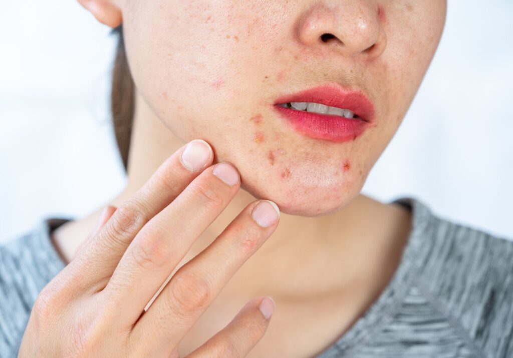 stop getting acne and pimples?