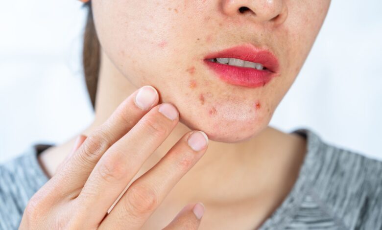 stop getting acne and pimples?