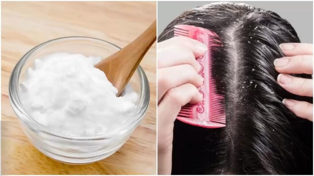  Baking Soda Helps in Reducing Dandruff