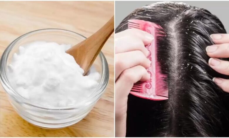 Baking Soda Helps in Reducing Dandruff