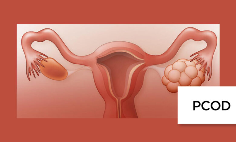 Treatment of PCOS