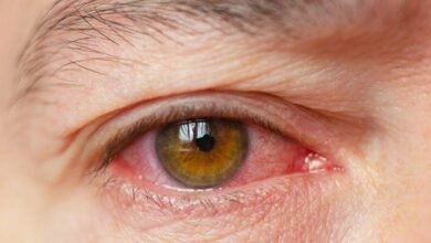 Home Remedies for Burning Eyes