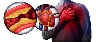 Heart Blockage