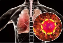 Lung Infection